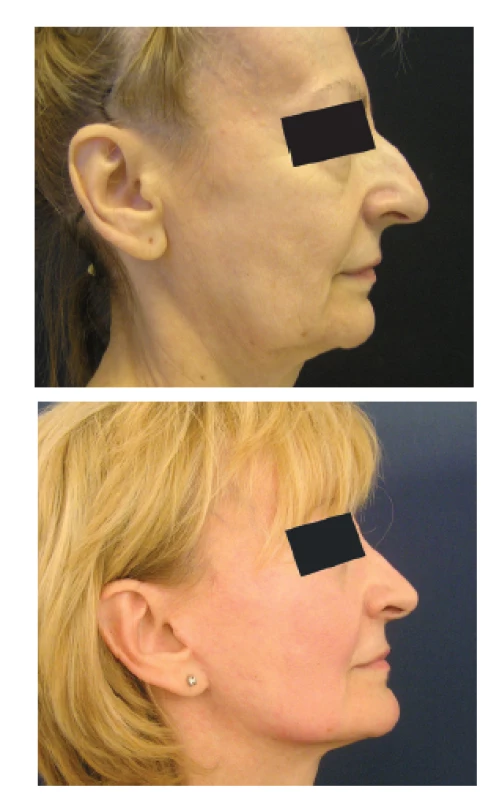 Rinoplastika u starší ženy po faceliftingu
Fig. 4: Rhinoplasty after facelift surgery in an older female