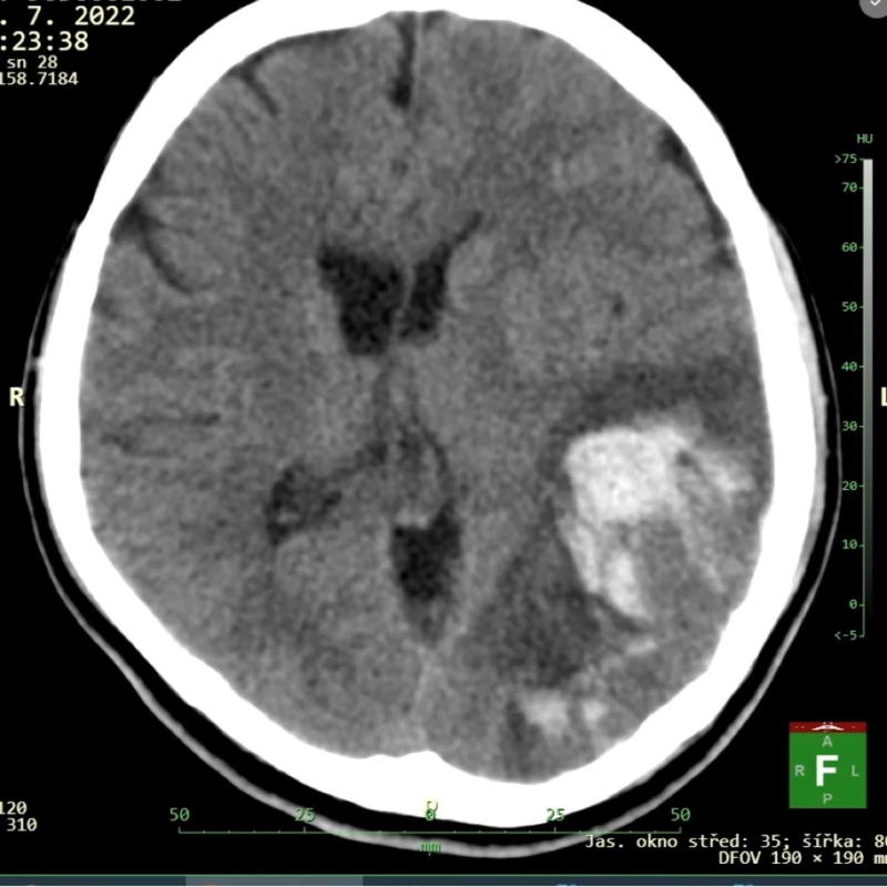 Obr. 4. Nativní CT s nálezem intracerebrálního hematomu v temporo-okcipitální oblasti na levé straně související s trombózou sinus transversus. .</br> Fig. 4. CT image showing intracranial hemorrhage in the temporo-occipital region on the left side.