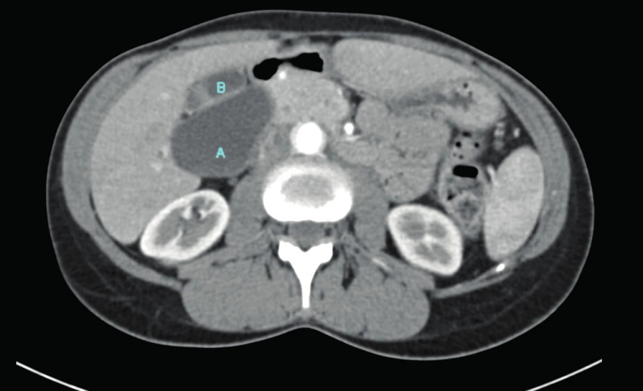 CT břicha v axiální rovině (A – cysta ductus choledochus, B – žlučník)
Fig. 1: Axial abdominal CT image (A – choledochal cyst, B – gall bladder)