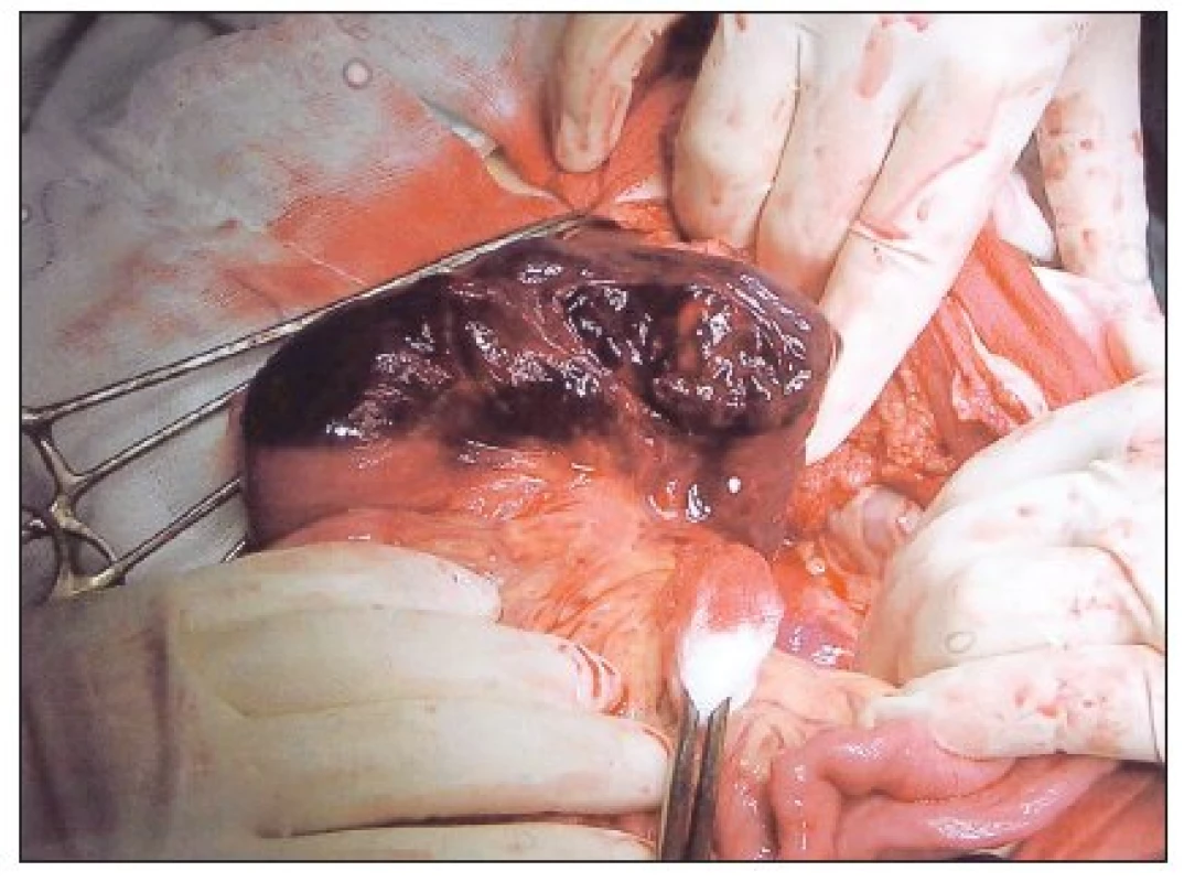 Intramurálny hematom pravej kľúčky jejuna po biopsii duodena
Fig. 1. Intramural hematoma of the right jejunal loop following duodenal biopsy
