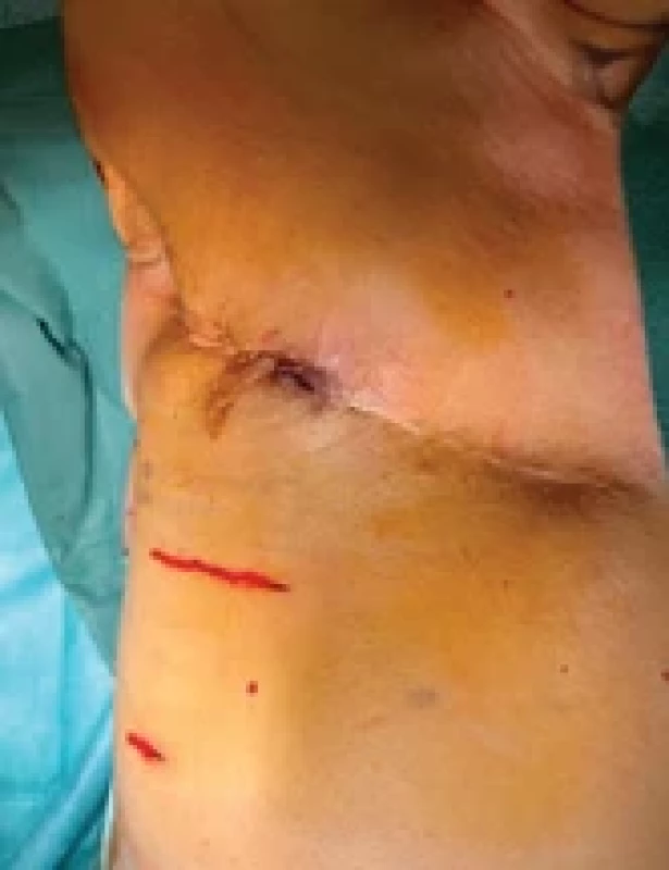 Třetí recidiva angiosarkomu. Fig. 2. Third recurrence of angiosarcoma.