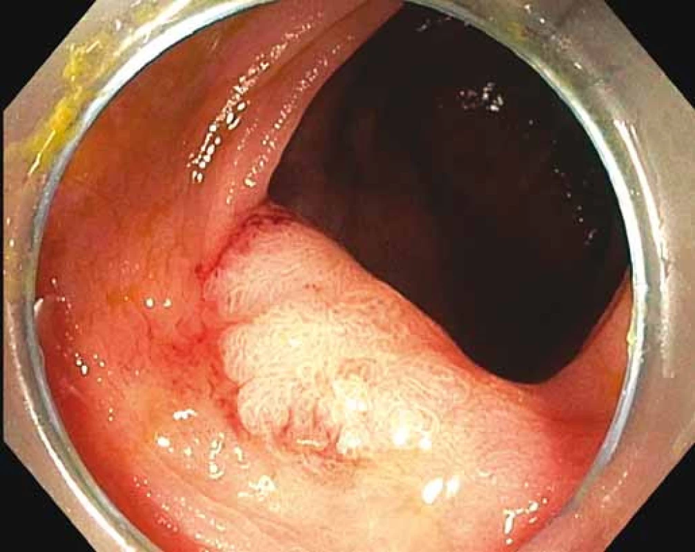 Lokální reziduální neoplazie v hepatální flexuře.
Fig. 1. Local residual neoplasia in the hepatic flexure.