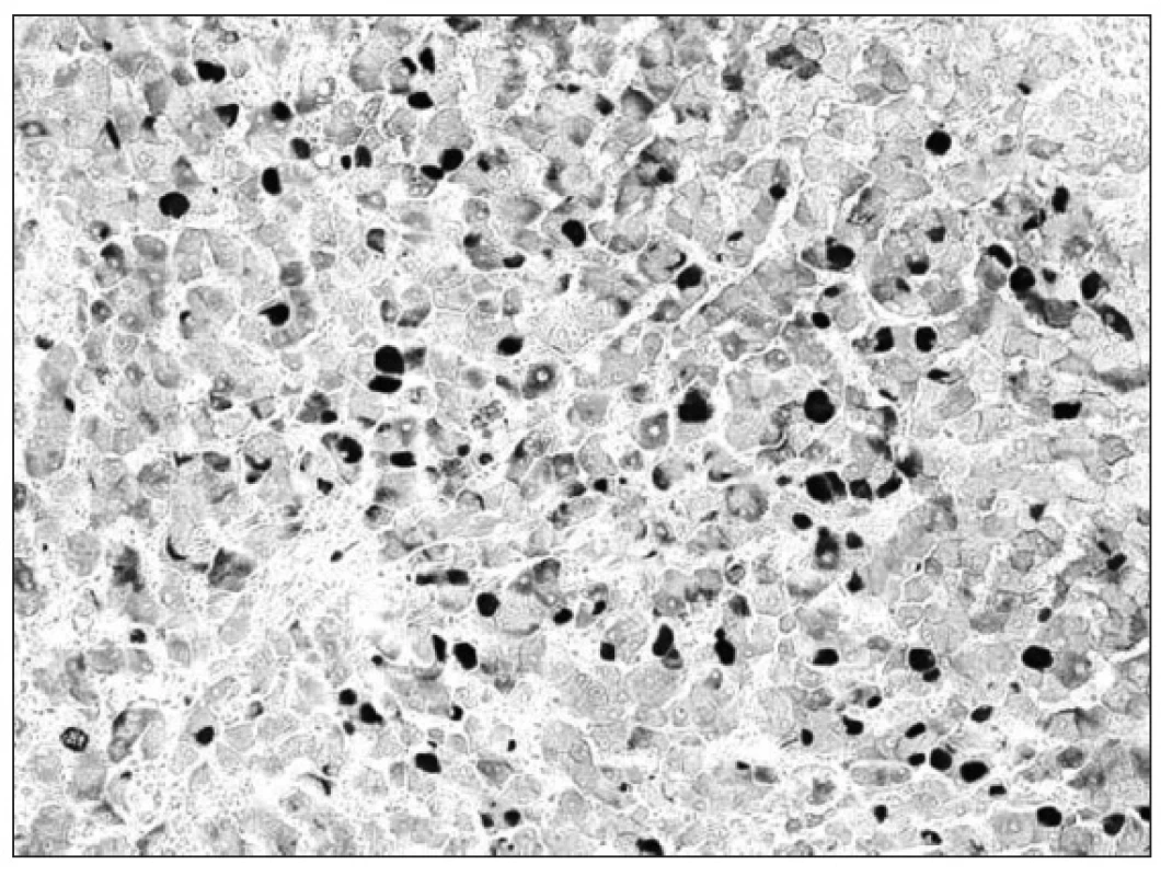 Chronická hepatitída B – imunohistochemická pozitivita HBsAg v hepatocytoch (50x).
Fig. 2. Chronic hepatitis B – immunohistochemical HBsAg positivity in hepatocytes (50x).