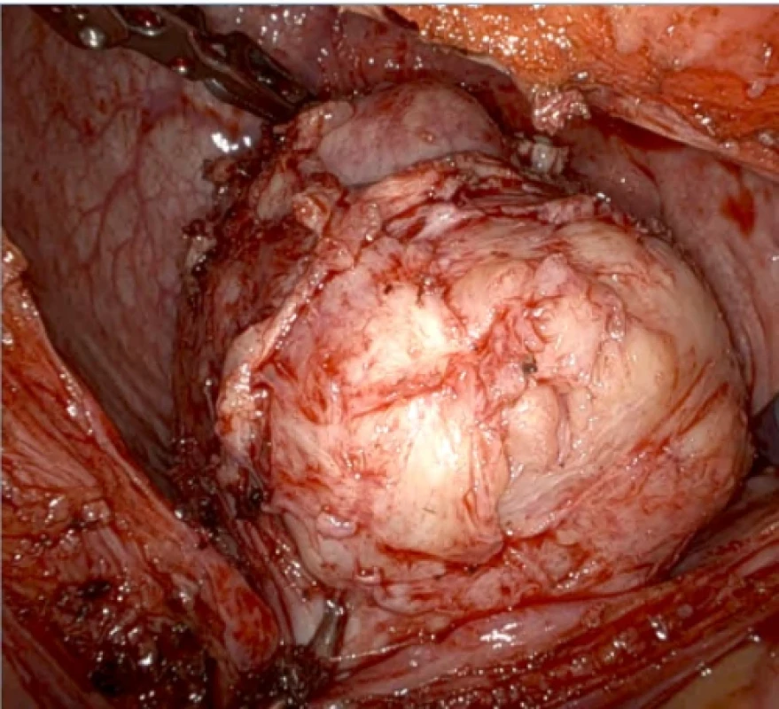 Objemný adenom prostaty. Fig. 3. Large prostate adenoma.