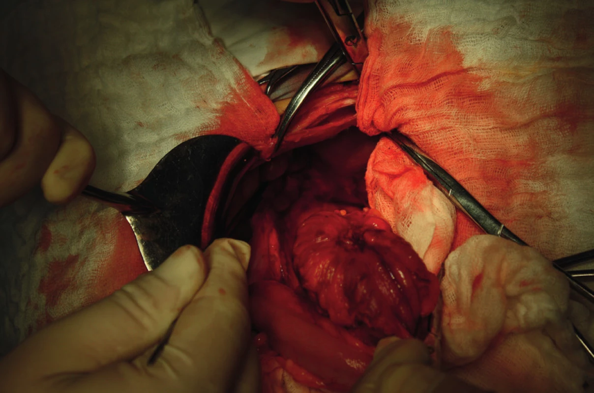 Colon sigmoideum infiltratívne zmenené
Fig. 1: Endometriosis of the colon sigmoideum