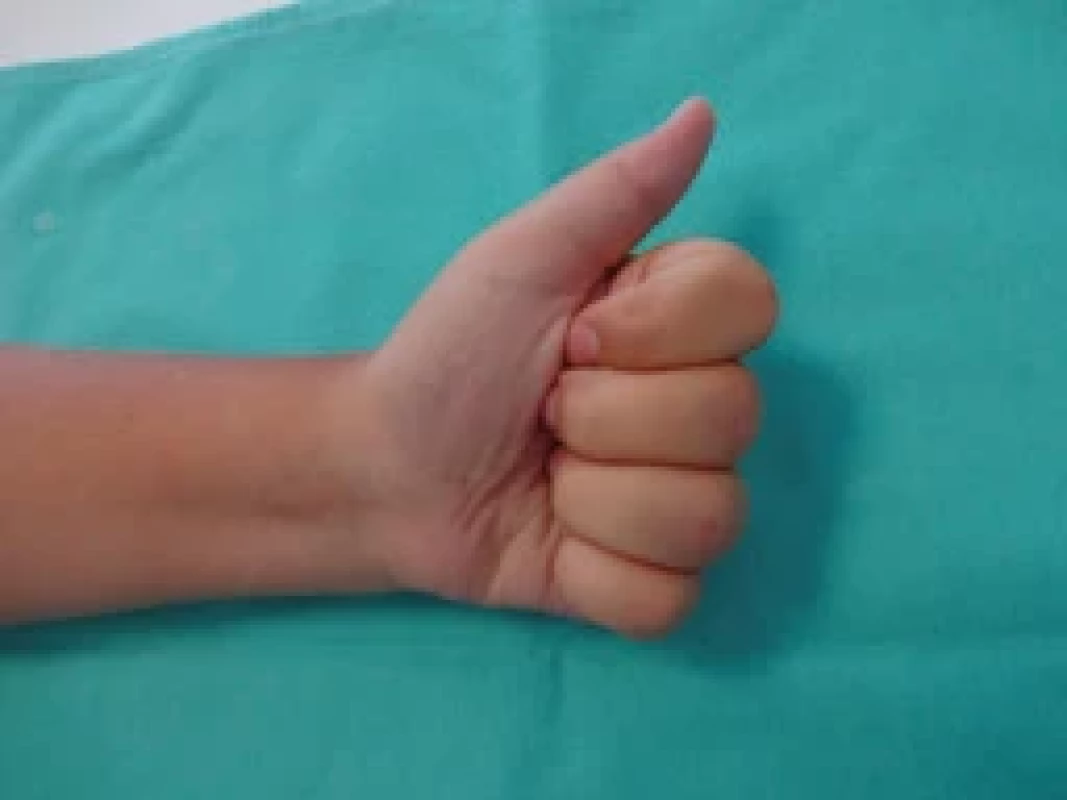 A full range painless motion postoperatively – fl exion.