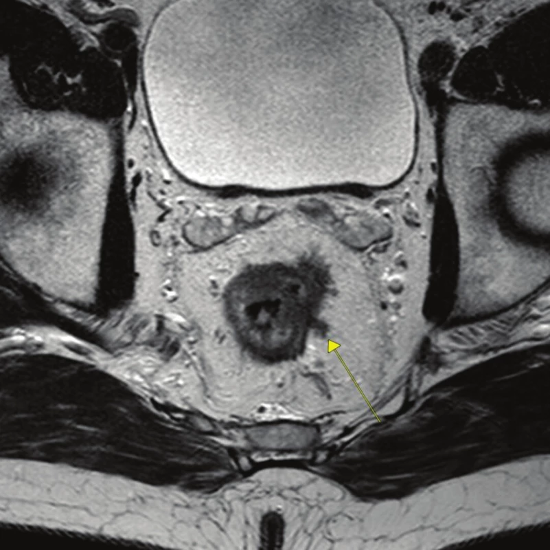 Ložisko extramurální vaskulární invaze (označeno šipkou)
Fig. 1: A vein with eMVI on MRI image (see arrow)