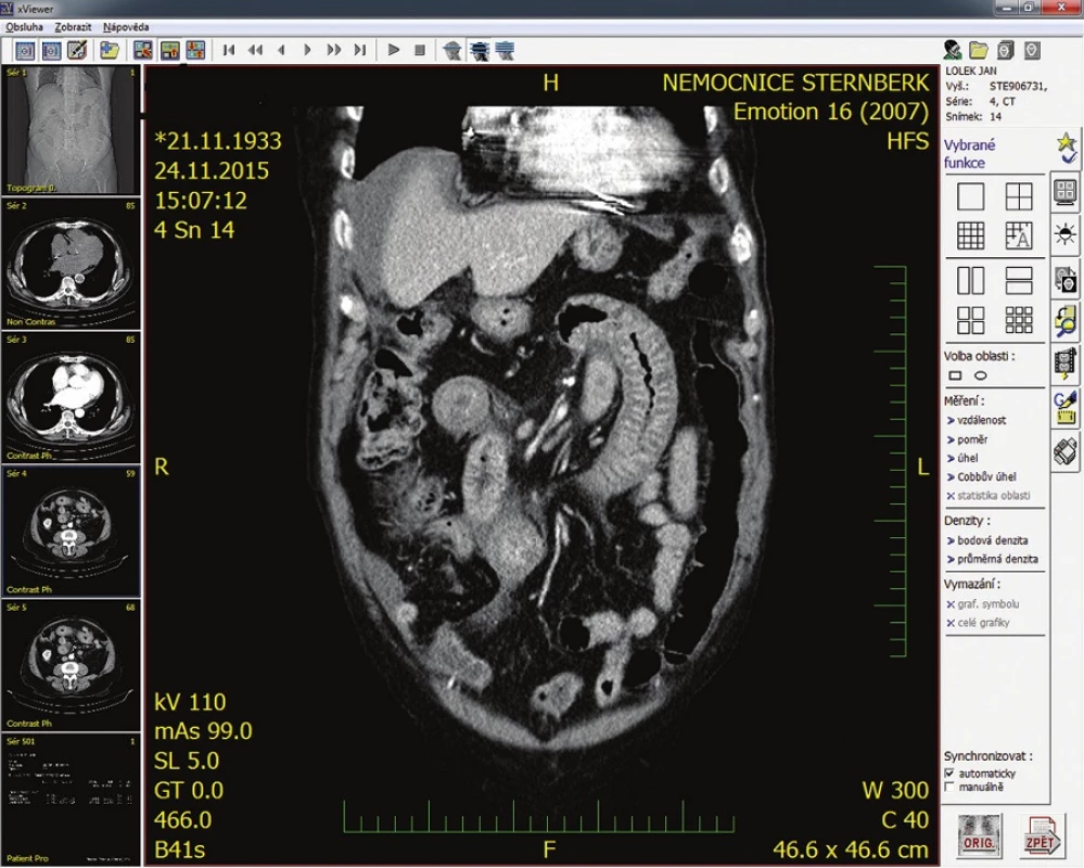 CT s infiltrovanou kličkou tenkého střeva
Fig. 2: CT with infiltrated small intestine