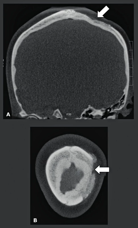 Protokol CBCT u preprotetického snímkování pro kraniální kostní štěp u atrofické maxily. Simultánní CBCT snímkování recipientní lokality maxilárních dutin a odběrového místa na lebce.