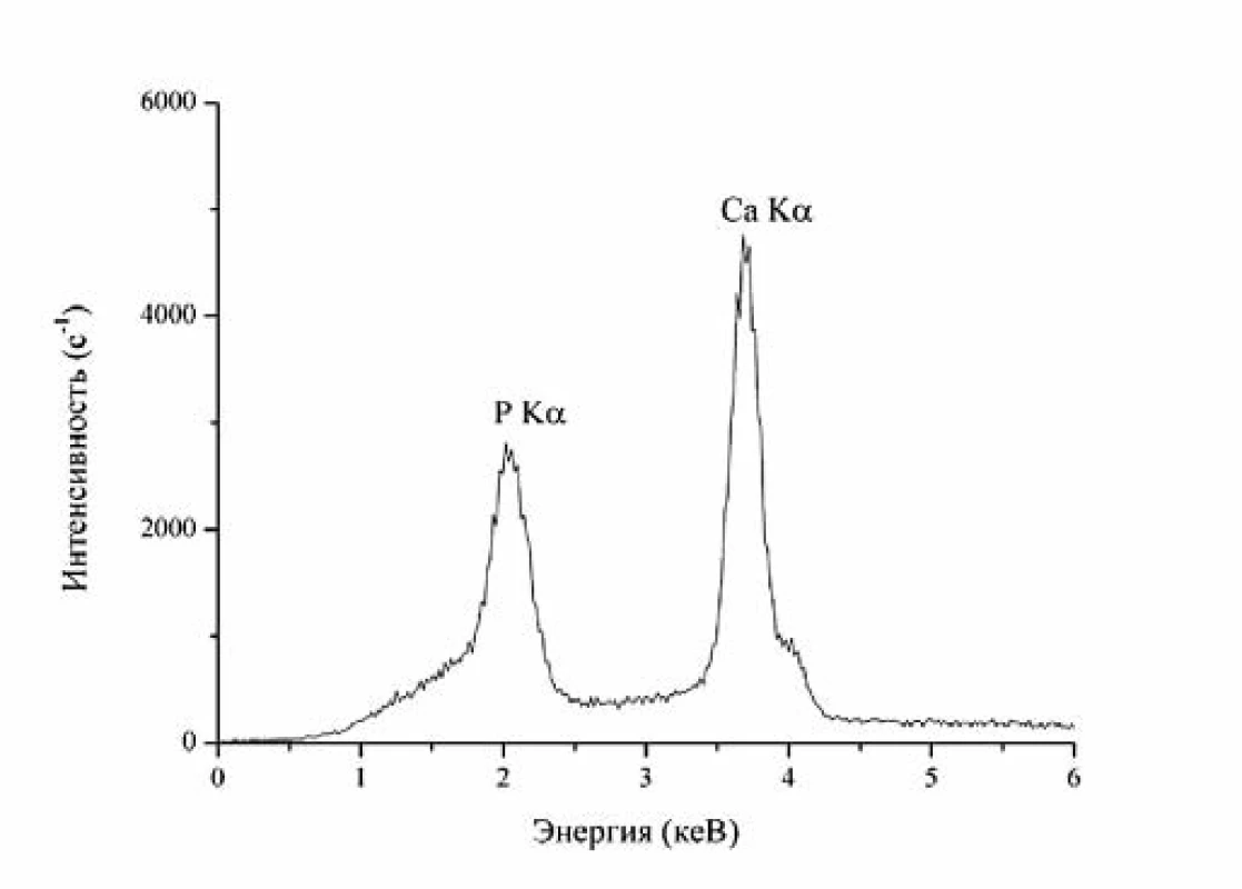 EDX spectrum of pathological mineral eye formation.