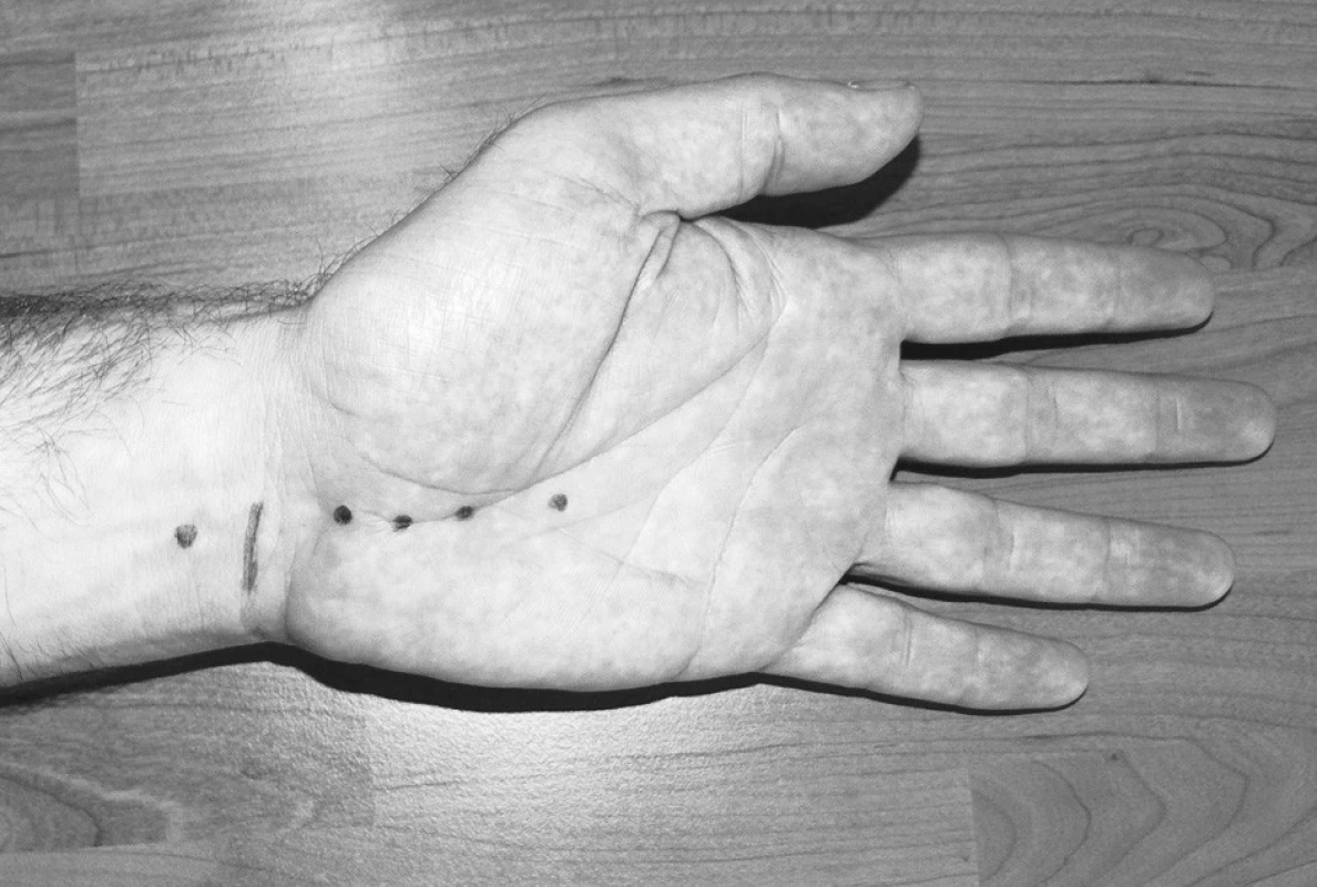 Schematické znázornění místa incize (příčná linie) a jednotlivých úrovní měření tlaků (body) 
Fig. 2. Schematic view of the incision site (transverse line) and of the individual pressure measurements levels (points)