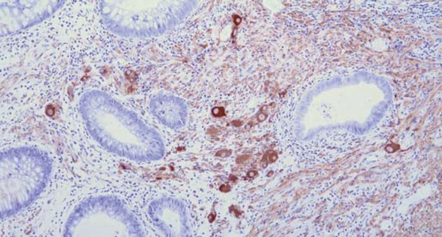 Speciální imunohistologické vyšetření na neuron specifickou enolázu a synaptofyzin, zvětšeno 200×.