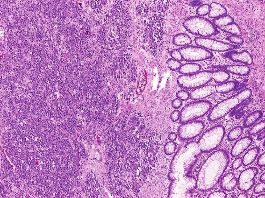 Histopatologický obraz maligního lymfomu tračníku typu plasmocytomu
Fig. 6: Histopathological finding of malignant lymphoma of the plasmocytoma type
