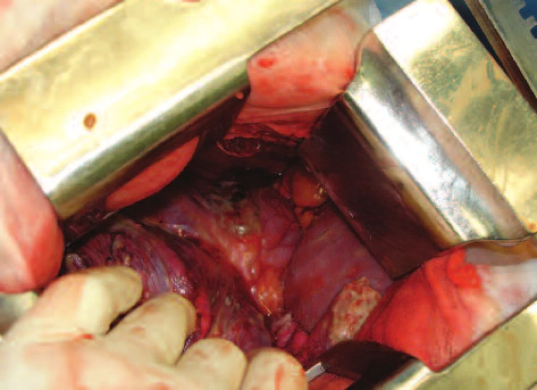 Nekróza v části předního mediastinina, pohled z pravostranné torakotomie
Fig. 5: Necrosis in the anterior mediastinum, view from right-sided thoracotomy