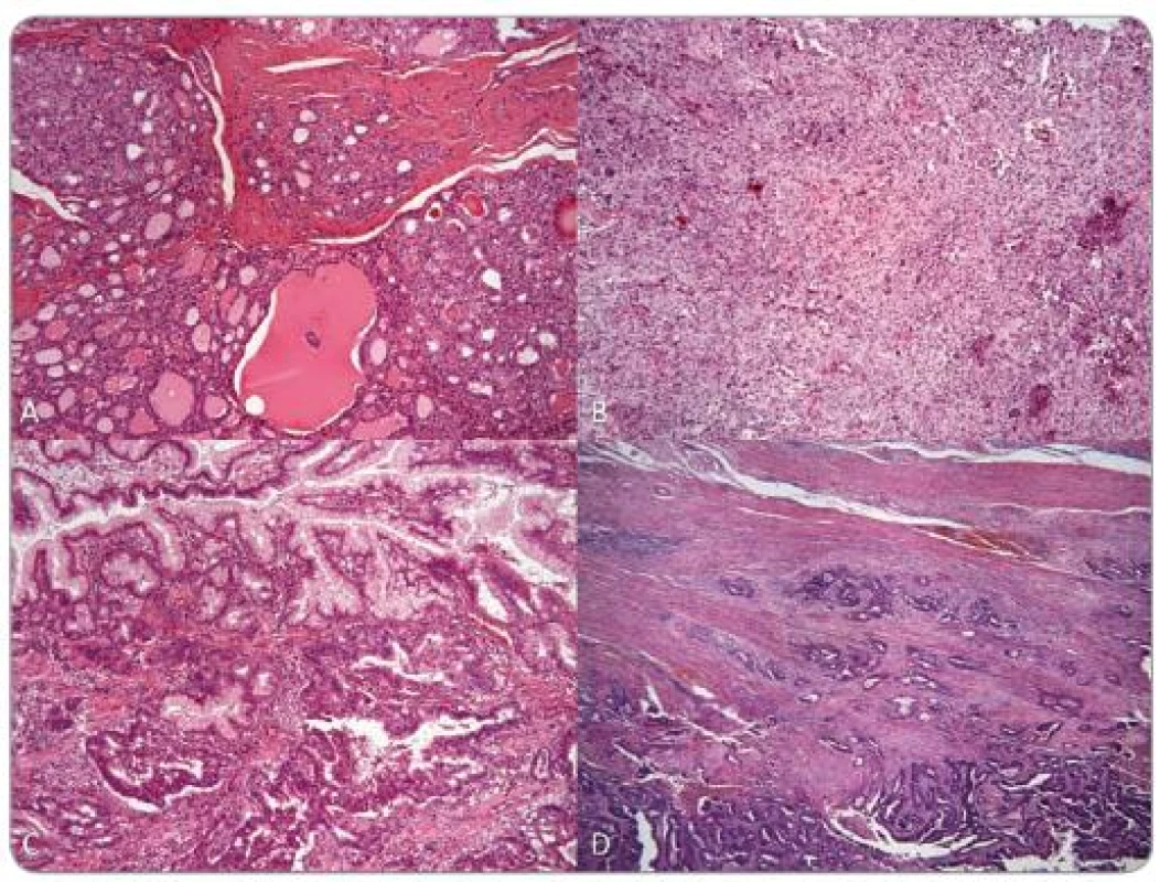 Pacient 2: histologické preparáty: A – folikulárny karcinóm šťítnej žľazy, B – meningeóm, C – hyperplastický polyp žalúdka s adenokarcinómom, D – tubulárny adenokarcinóm hrubého čreva