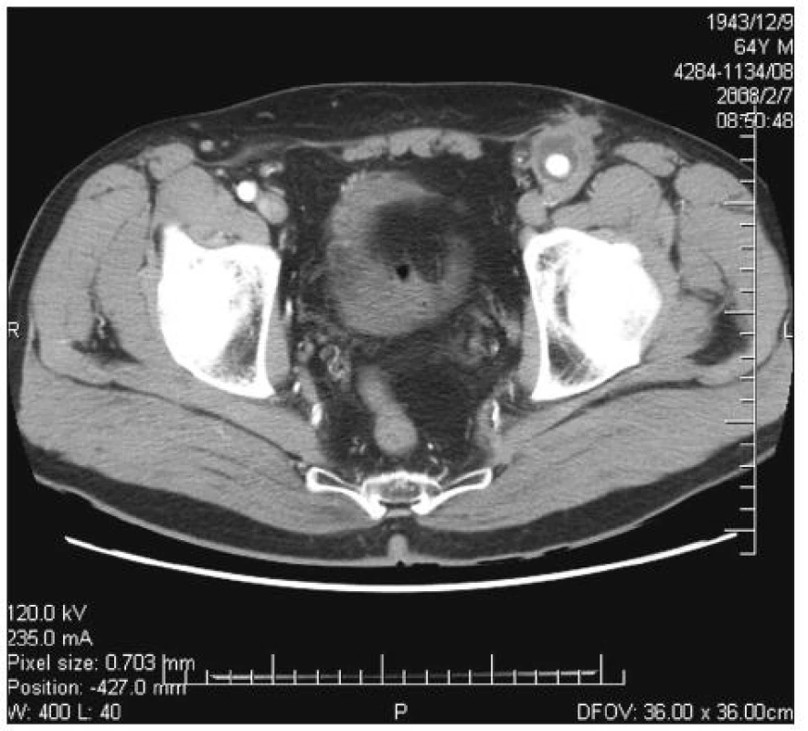 Infekce aorto-femorální cévní protézy vlevo. CT obraz abscesu kolem cévní protézy v oblasti nad tříselným vazem
Fig. 1. Infected left aorto-femoral prosthetic graft. CT image of an abscess around the vascular prosthesis in the suprainguinal area
