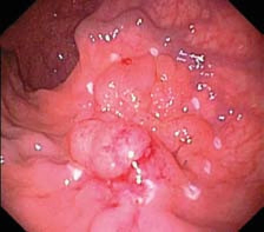 Povrchová neoplastická léze typu LST s jizevnatými změnami. Okraje léze označeny koagulačními značkami.
Fig. 2. LST-type superficial neoplastic lesion with cicatricial changes. Edges of lesion marked with coagulation marks.