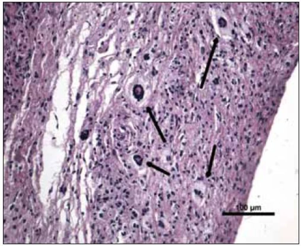 Barvení hematoxylin-eozin, původní zvětšení 200krát. Vazivová tkáň se zánětlivou infiltrací histiocyty a charakteristickými obrovskými mnohojadernými buňkami Toutonova typu (šipky).
