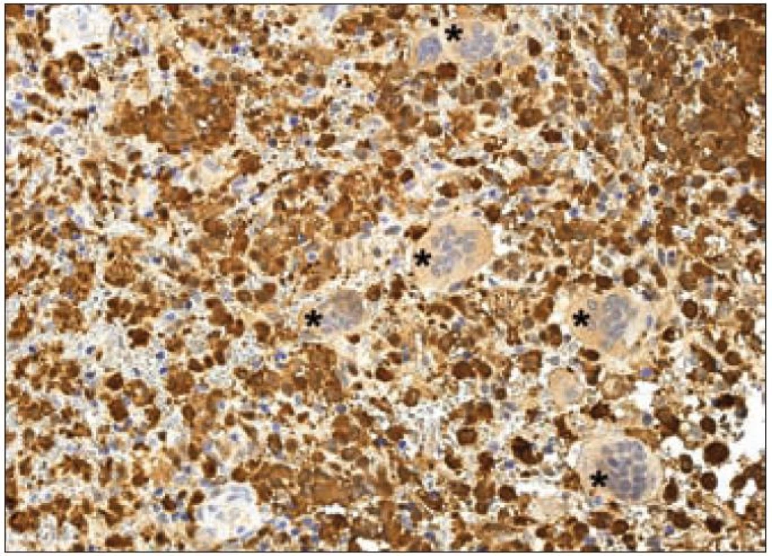 S-100 protein – imunohistochemické vyšetření. Cytoplazmatická i jaderná pozitivita Langerhansových buněk kostního infiltrátu LCH (hnědý precipitát), osteoklasty (označeny hvězdičkami) se pouze přibarvují, jádra dobarvena hematoxylinem.