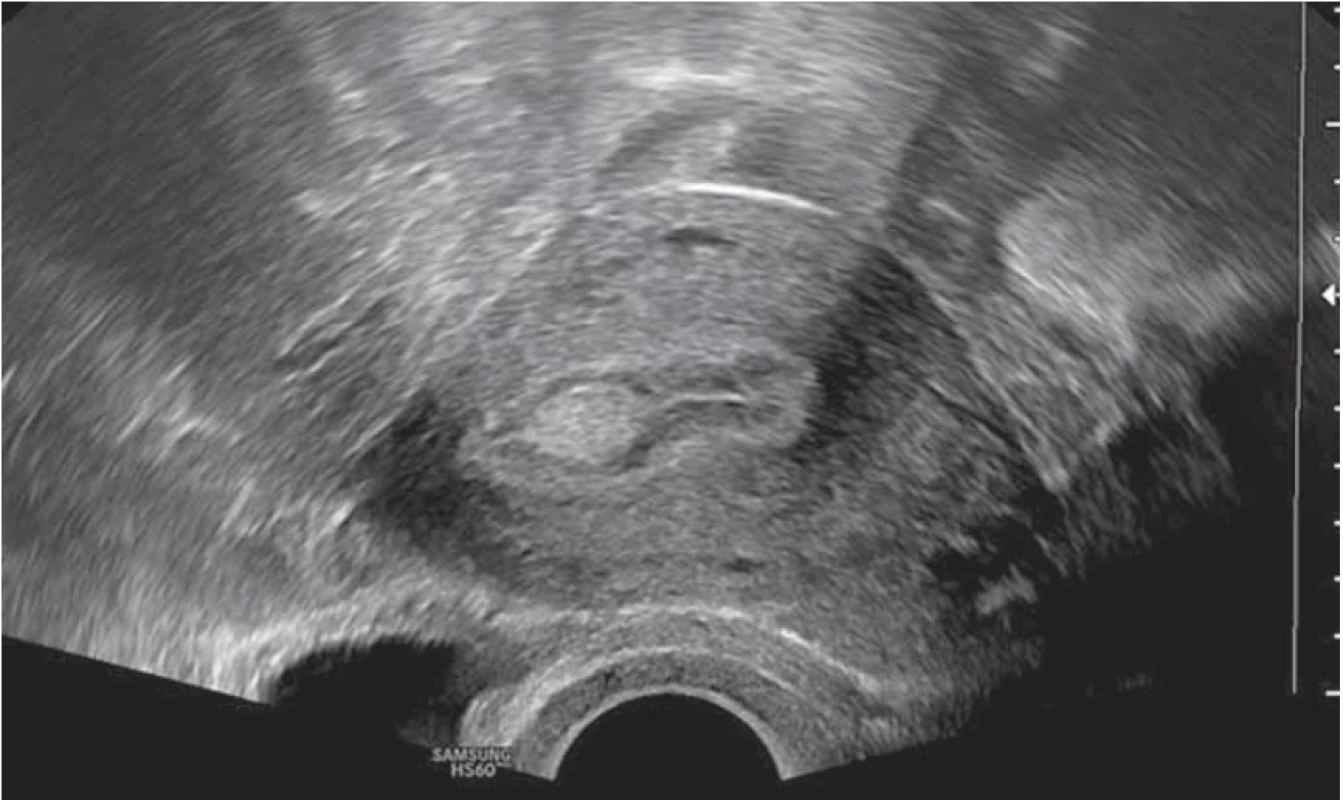Hyperechogenní homogenní endometriální polyp u premenopauzální pacientky. // Hyperechogenic homogenous endometrial polyp in premenopausal patient.
