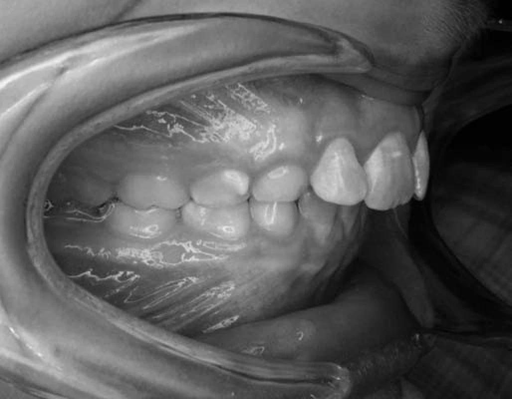 Predhryz u pacienta č. 3.
Fig. 5. Overjet in patient No. 3.