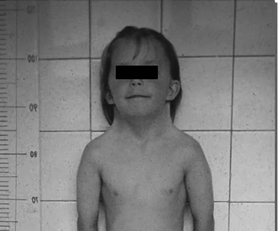 Pacientka se stigmaty typickými pro TS (archiv autorů).
Fig. 2. Female patient with stigmas typical for TS (authors’ archive).