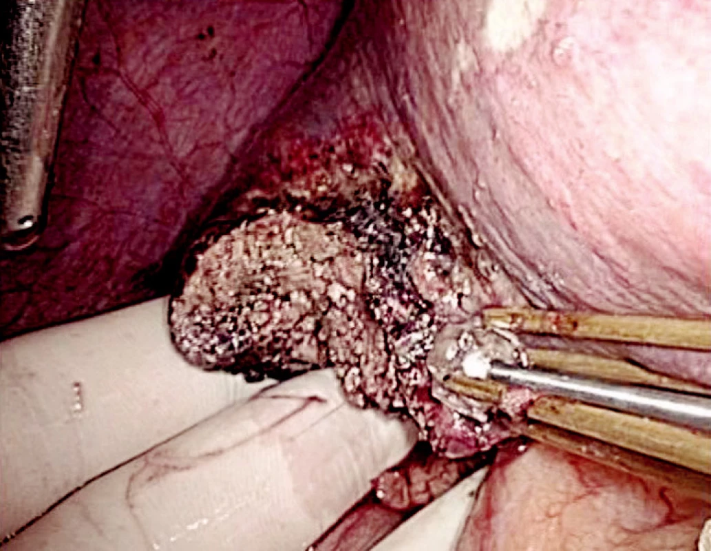 Suché operační pole po RFA resekci
Fig. 6. Dry operating field following RFA resection