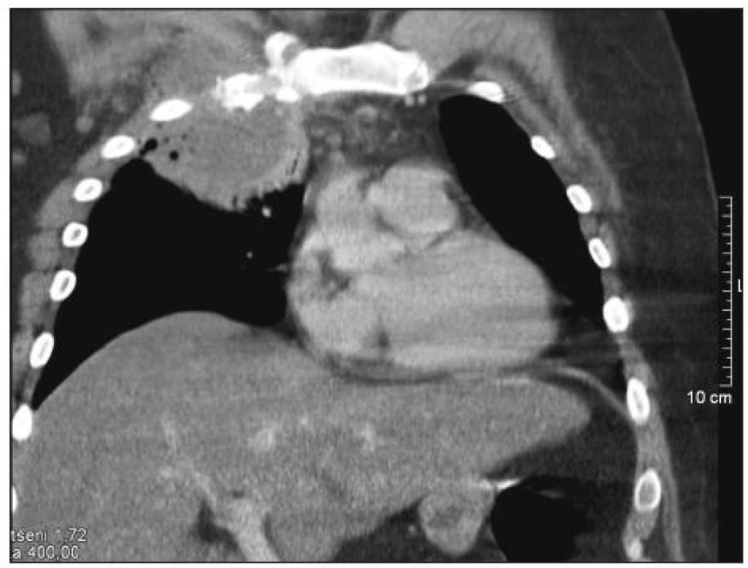 CT scan hrudníku s abscesem při zánětu sternoklavikulárního kloubu (kazuistika č. 2)
Fig. 2. CT scan of the chest (case report No. 2)