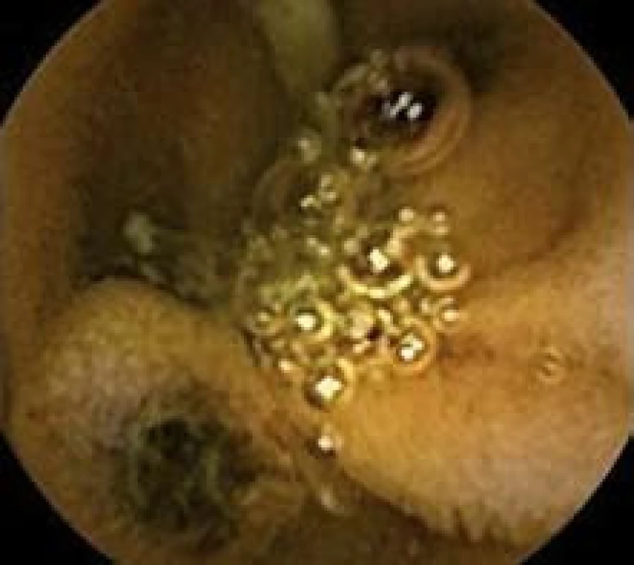 Polyp jejuna, kapslová enteroskopie.
Fig. 3. Polyp in jejunum, capsulle enteroscopy.