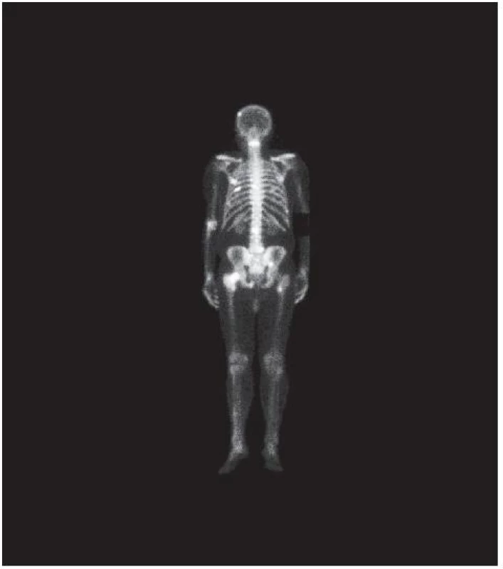 Scintigrafie skeletu s nálezem metastáz (kalva, levá parietální kost, sternum, obratle C3, Th7, L2, pravá kyčel, stydká kost, levá stehenní kost) 
Fig. 4. Bone scintigraphy with the presence of metastase (skull, left os parietale, sternum, vertebrae C3, Th7, L2, right ilium, os pubis, left femur)