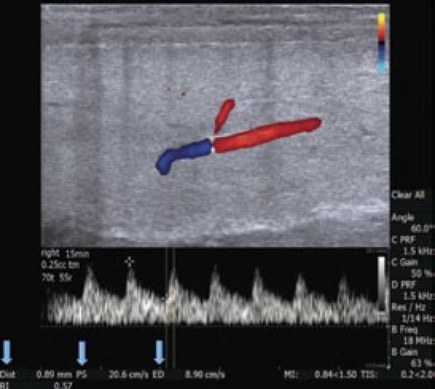 Kavernózní arterie 15 min po injekční aplikaci TriMixu. Směr toku krve při dopplerovském nastavení. Zobrazeny jsou následující parametry: průměr arterie (0,89 mm), PSV (20,6 cm/s), EDV (8,9 cm/s) a kalkulovaný RI (0,57). Úhel vyšetřovací sondy je 60°. Pro optimální měření je vzdálenost mezi kalipery přizpůsobena 3/4 šíře arterie.