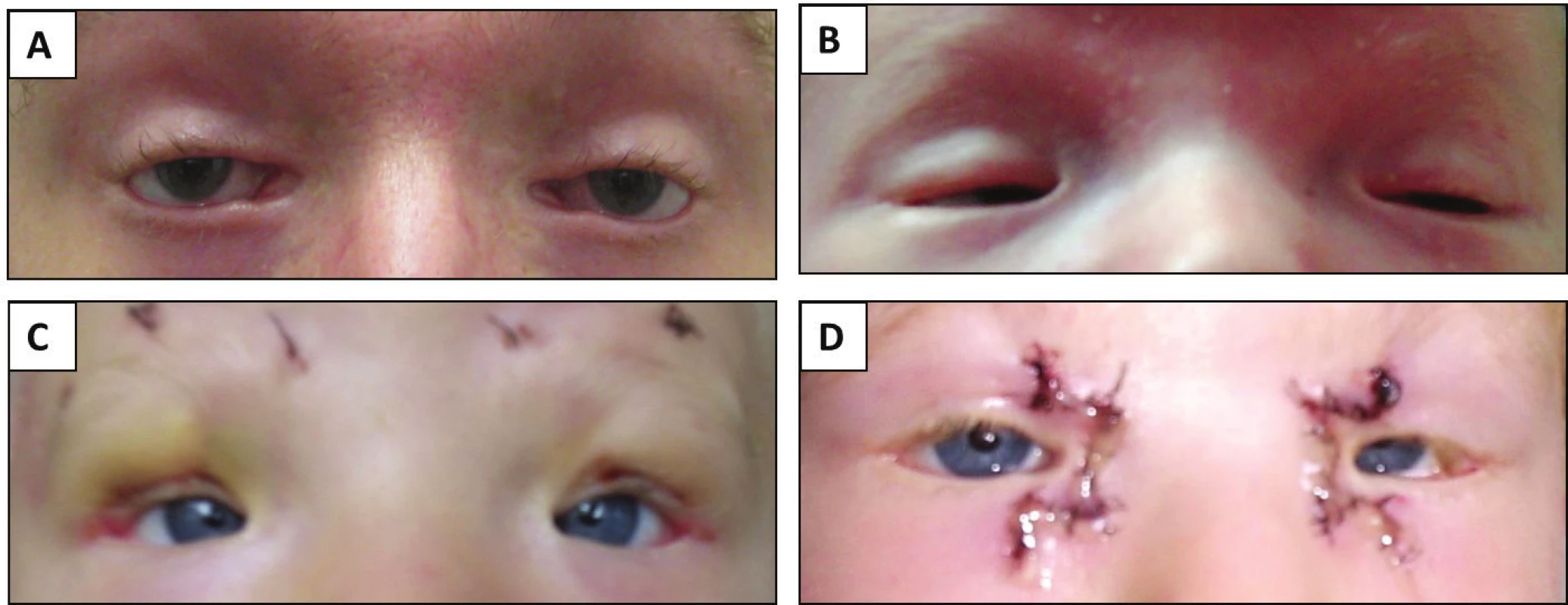 Fotografie očí a jejich okolí jedinců se syndromem blefarofimóza-ptóza-epikantus inverzus, A) vyšetřovaný proband, B) syn probanda ve věku 10 dnů, C) syn probanda ve věku 2 let po druhé závěsné operaci d) syn probanda ve věku 4 roky po dvojité Z let plastice. Chirurgické zákroky nebyly provedeny na pracovištích autorů této práce