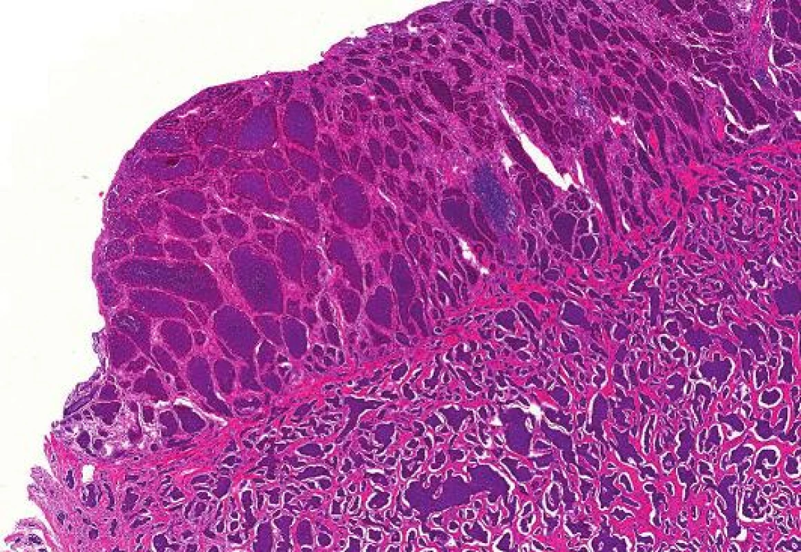 Dobře diferencovaný neuroendokrinní tumor terminálního ilea, barvení HE (zvětšení 40x).