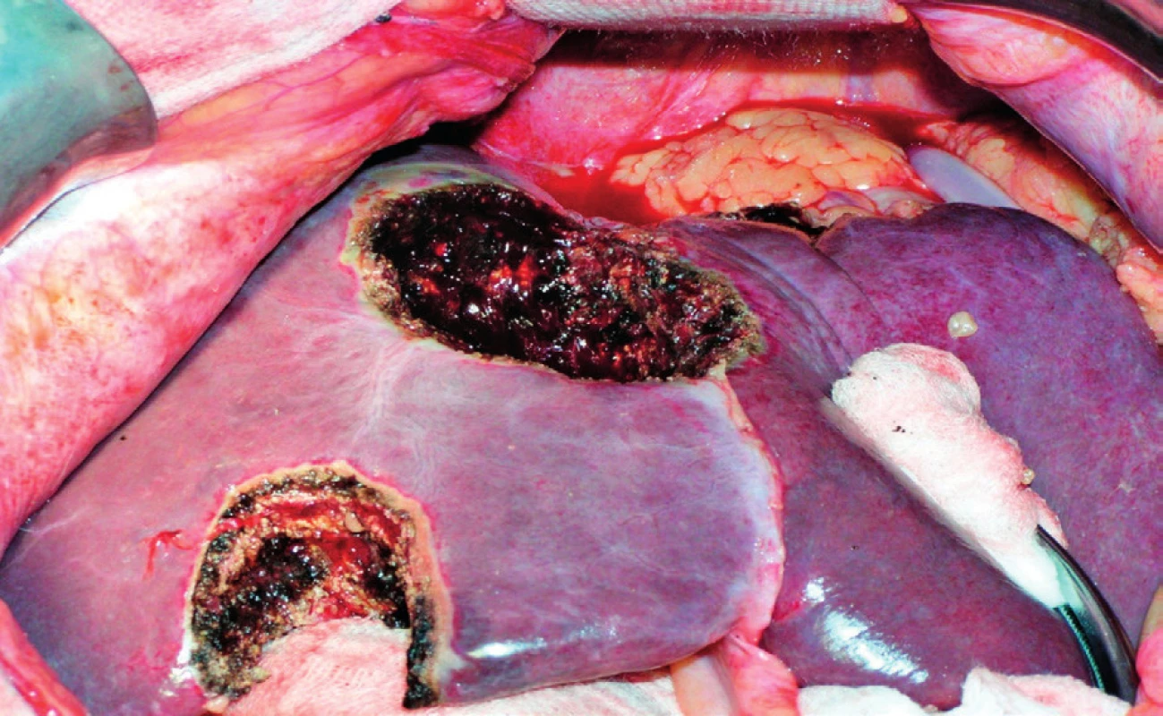 Stav po metastasektomii jater – 2krát neanatomická resekce