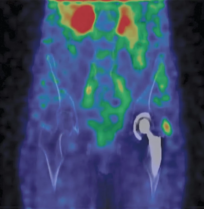 Fúze SPECT/CT bederní páteře a pánve v časné fázi v koronárním řezu – zvýšený krevní pool v místě úponů svalů na velkém trochanteru levého femuru.