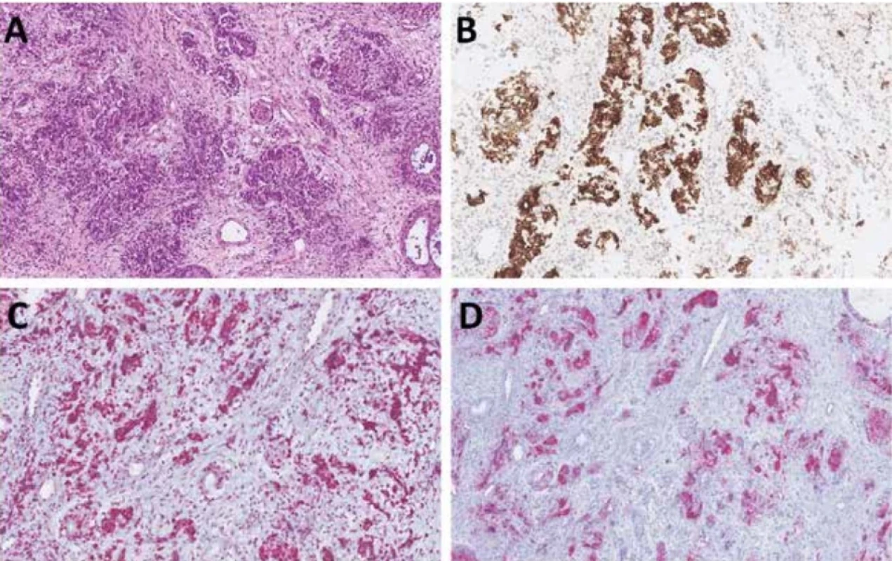 Olfaktorický karcinom je velkobuněčný neuroendokrinní nádor nejspíše epiteliálního původu morfologicky připomínající olfaktorický neuroblastom (A). V tomto případě s difúzní expresí cytokeratinového koktejlu AE1/AE3 (B), INSM1 (C) a SSTR2 (D).