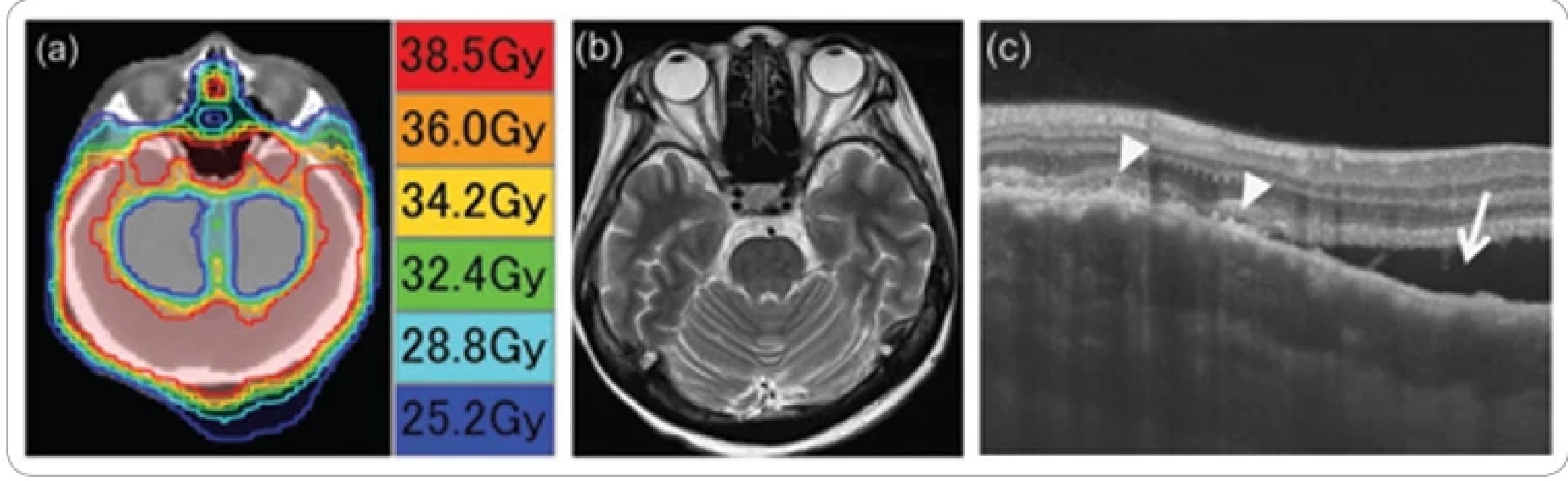  A 54-year-old female with choroidal metastasis of breast cancer in the right eye. (a) Isodose lines of hippocampal avoiding whole brain radiotherapy with corresponding actual radiation dose. The intraorbital proximal 5 mm of both optic nerves were irradiated with a mean dose of 40 Gy in 20 fractions using helical tomotherapy. (b) T2-weighted turbo spin-echo MRI showed no metastatic tumors in the brain or eyes. (c) Optical coherence tomography demonstrated the irregular and undulating anterior surface (arrowheads) with subretinal fl uid (arrow).