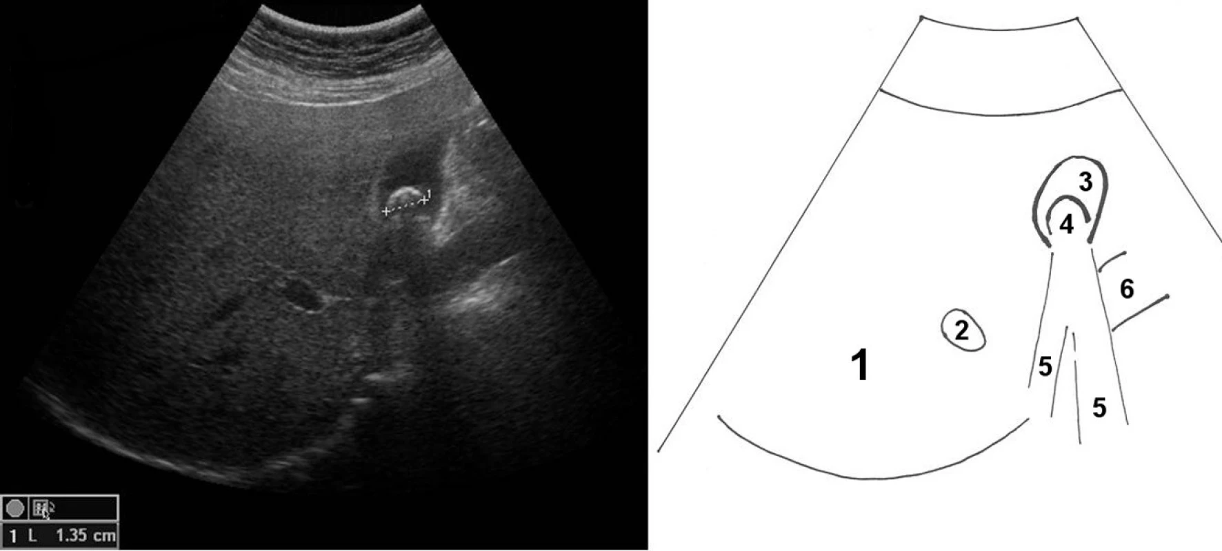 Solitární cholecystolitiáza; příčně zobrazena játra se žlučníkem, 1 – jaterní parenchym, 2 – hlavní větev portální žíly v pravém laloku jater, 3 – žlučník s hypoechogenním obsahem, 4 – konkrement ve žlučníku, 5 – akustický stín konkrementu, 6 – vena portae v jaterním hilu