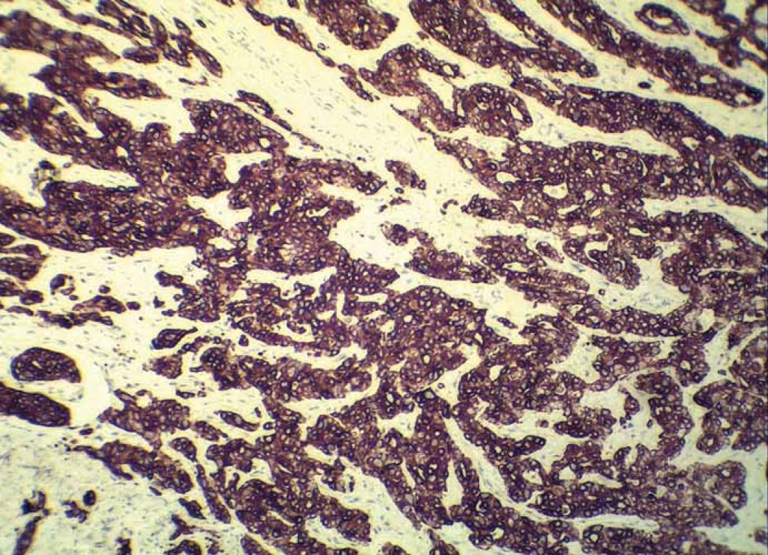 Strong immunoreactivity of adenocarcinoma for cytokeratin 7 (clone OV-TL 12/30, Dako, magnification 200×).