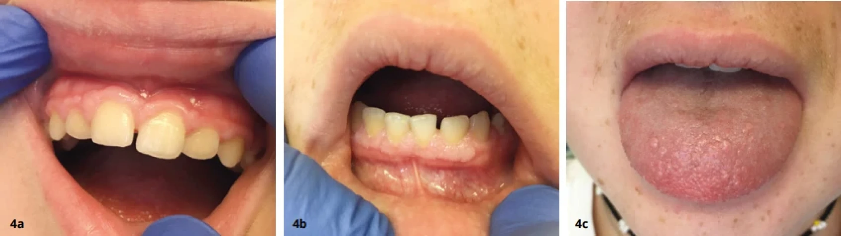 Stav gingivy v horním (a) a dolním (b) frontálním úseku a změny na jazyku (c) ve věku 12 let. Zdroj: Dokumentace pacientky. Fig. 4 Condition of the gingiva in the upper (a) and lower (b) anterior region and changes on the tongue (c) at the age of 12 years. Source: Patient's medical records.
