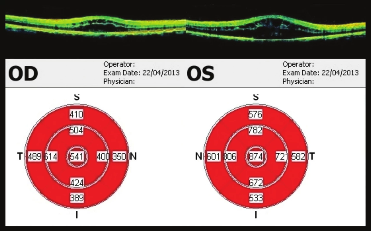 OCT makul 22 týdnů od prvního vyšetření
Progrese nálezu – výrazná cystoidní přestavba, ve fovee 541 μm na OP, na OL 874 μm. Pacient indikován k aplikaci bevacizumabu do OP