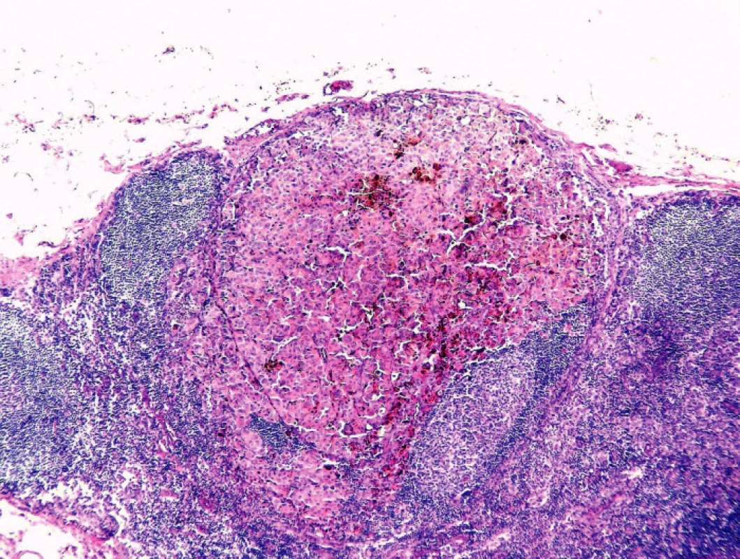 Metastáza melanomu s přítomností melaninu (HE, 100x).