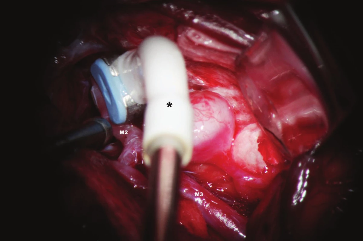 Sonda (*) k měření průtoku krve (flowmetrie) v mozkových cévách
M2, M3 - větvení a. cerebri media
Fig. 1: Perivascular flow probe (*)
M2, M3 - MCA branches
