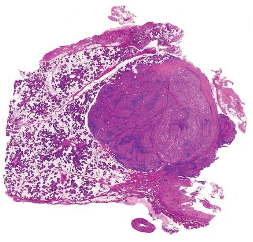 Well differentiated acinic cell carcinoma with lymphoid stroma mimicking metastatic acinic cell carcinoma within a lymph node (A). Round shaped mass of acinic cell carcinoma with lymphoid stroma. No sinuses can be recognized (B) (magnification 10x and 200x, resp.).