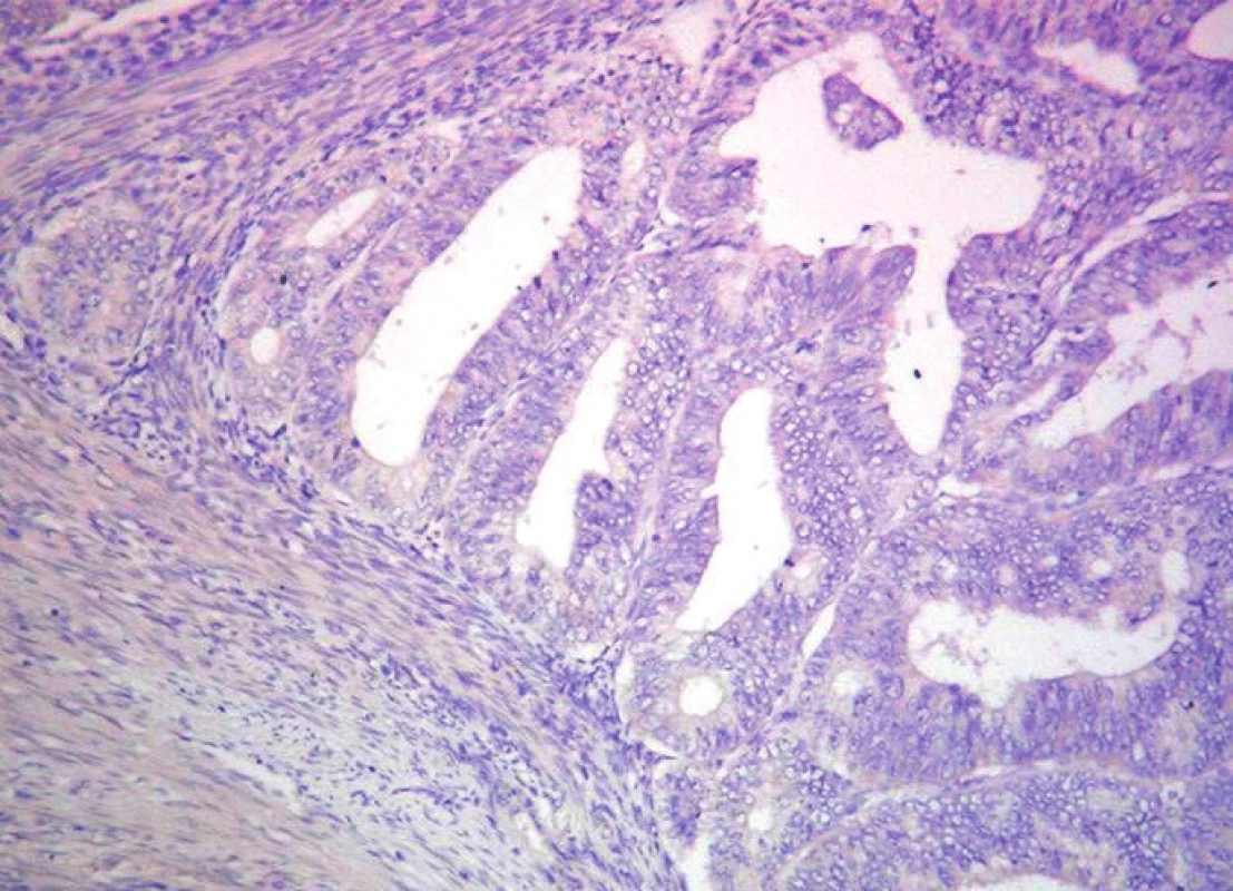 Neprítomnosť expresie p53 v endometrioidnom CaE. Imunohistochemické vyšetrenie s protilátkou proti p53. ABC-Px, 100x