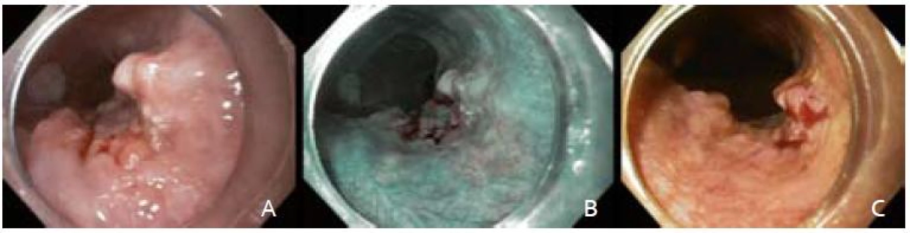Endoskopické snímky včasného ESCC. A – zobrazenie bielym svetlom, B – zobrazenie v NBI, C – farbenie Lugolovym roztokom.
Fig. 1. Endoscopic images of an early ESCC. A – white light endoscopy, B – narrow band imaging, C – Lugolʹs staining.