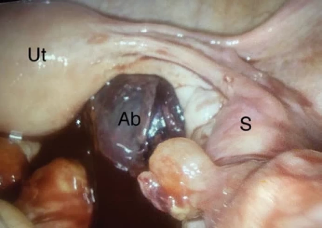 Fotografie peroperačního nálezu s vyznačenými strukturami.</br>Fig. 3. Photograph of intraoperative finding with marked structures.