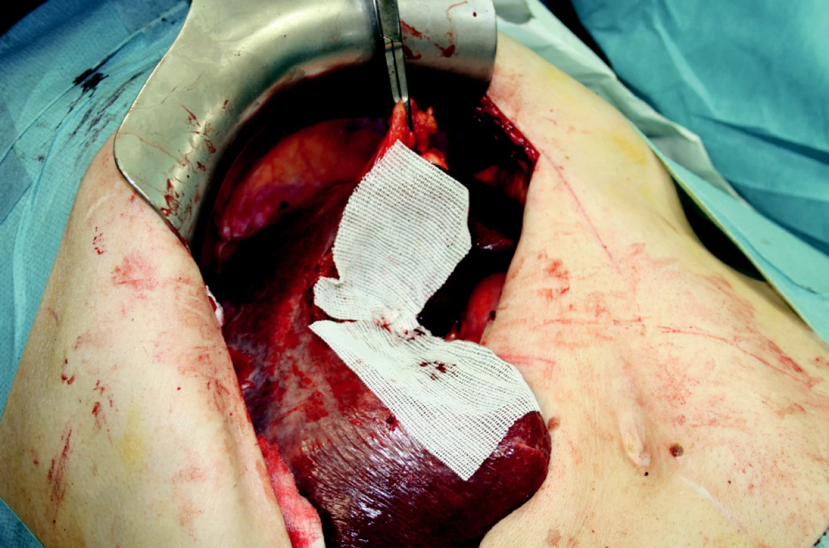 Extraanatomická resekce jater s překrytím resekčních ploch
Obr. 3. Extraanatomic resection, surfaces covered with Traumacel TAF
