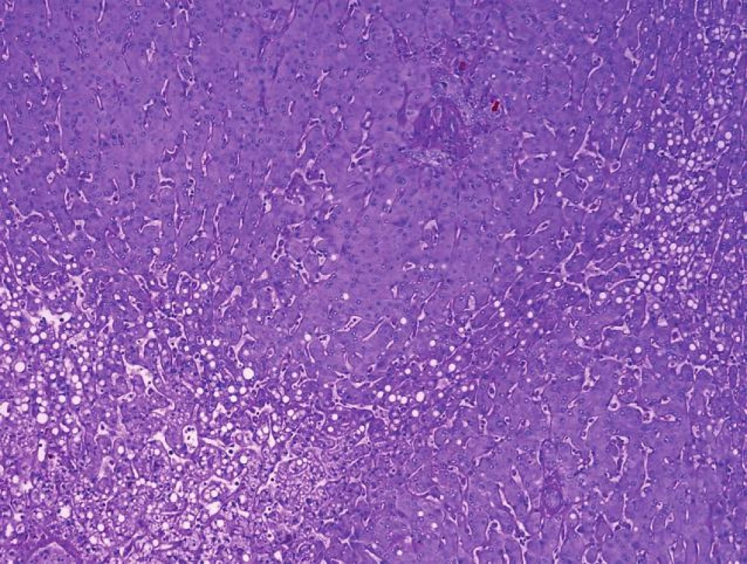 Morfologie nekróz a navazujících metabolických změn (se steatózou a cholestázou) v centrolobulárních oblastech s centrocentrálním přemostěním jako součást „small for size“ syndromu u pacientky transplantované částí splitovaných jater.