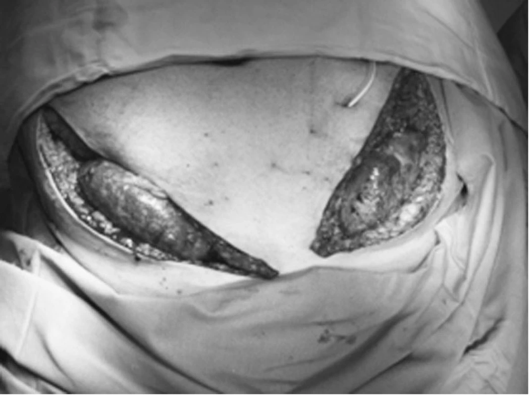 Bilaterální transplantace ledvin
Fig. 3. Bilateral kidney transplantation